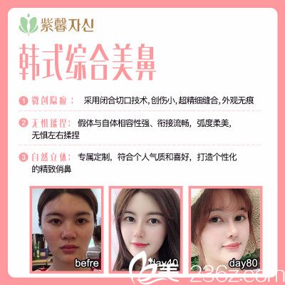 廣州紫馨姬付康做的隆鼻子案例 廣州紫馨姬付康做的隆鼻子案例