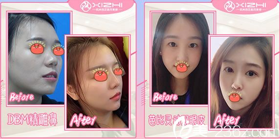 杭州網(wǎng)紅醫(yī)院西芷雙眼皮和隆鼻