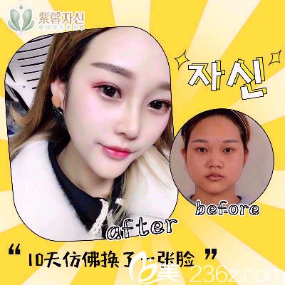 廣州紫馨李政祐做的隆鼻子案例 廣州紫馨李政祐做的隆鼻子案例