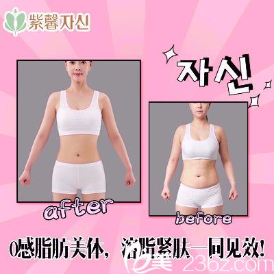 廣州紫馨全身吸脂案例 廣州紫馨全身吸脂案例