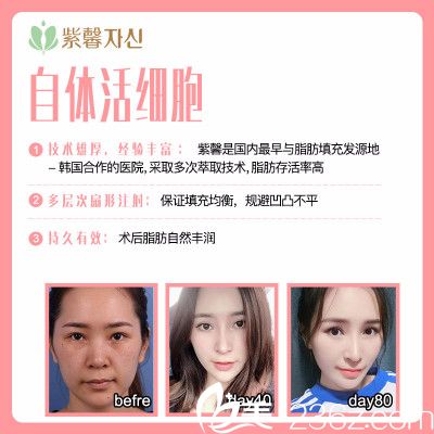 廣州紫馨自體脂肪填充案例 廣州紫馨自體脂肪填充案例