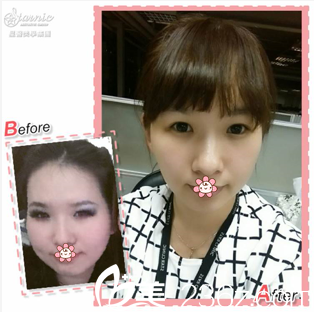 中國(guó)臺(tái)灣星和整形楊志雄Ultherapy極線音波拉提案例 中國(guó)臺(tái)灣星和整形楊志雄Ultherapy極線音波拉提案例