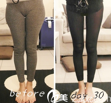 中國臺灣童顏醫(yī)療美容腿部吸脂案例 中國臺灣童顏醫(yī)療美容腿部吸脂案例