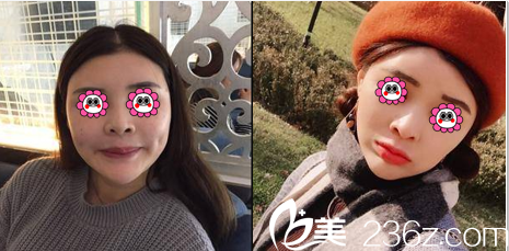 中國臺灣童顏醫(yī)療美容瘦臉除皺瘦臉案例 中國臺灣童顏醫(yī)療美容瘦臉除皺瘦臉案例