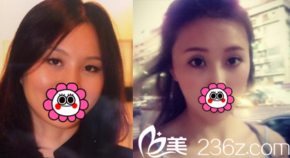 中國臺灣童顏醫(yī)療美容雙眼皮開眼角案例 中國臺灣童顏醫(yī)療美容雙眼皮開眼角案例