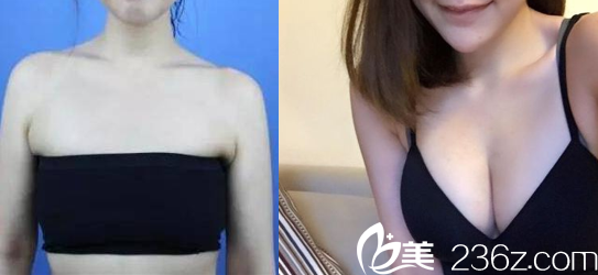 中國臺灣童顏醫(yī)療美容自體脂肪豐胸案例 中國臺灣童顏醫(yī)療美容自體脂肪豐胸案例