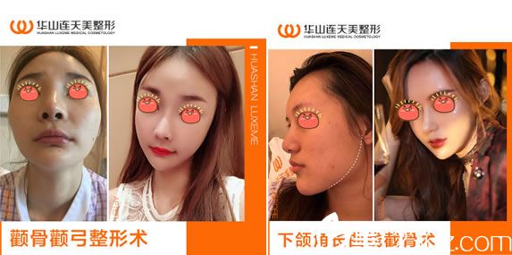 網(wǎng)紅選擇杭州連天美做下頜角顴骨 網(wǎng)紅選擇杭州連天美做下頜角顴骨