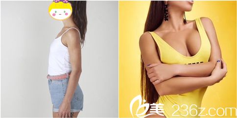 重慶華美假體隆胸案例效果