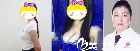 楊麗萍主任隆胸手術(shù)前后對比