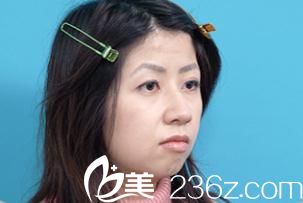 白壁征夫醫(yī)生面部拉皮手術(shù)前 白壁征夫醫(yī)生面部拉皮手術(shù)前