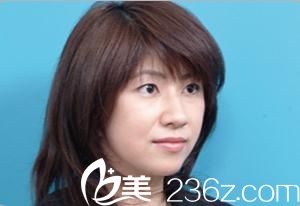 日本Sapho 面部拉皮三個月后 日本Sapho 面部拉皮三個月后