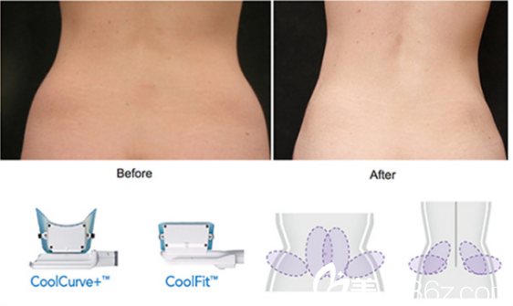 羅也納皮塔亞功醫(yī)生講冷凍溶脂以及案例分享 羅也納皮塔亞功醫(yī)生講冷凍溶脂以及案例分享
