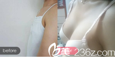 北京藝星鄭仕平醫(yī)生自體脂肪豐胸案例 北京藝星鄭仕平醫(yī)生自體脂肪豐胸案例