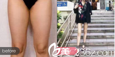 北京藝星鄭仕平醫(yī)生腿部吸脂案例 北京藝星鄭仕平醫(yī)生腿部吸脂案例