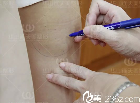 用筆畫出注射瘦腿的注射點