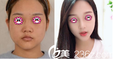 北京美萊宮風(fēng)勇自體軟骨墊鼻尖案例