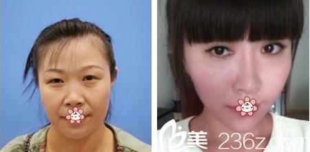 泰國(guó)曼谷KTOP整形巴尼厝洛雙眼皮隆鼻案例