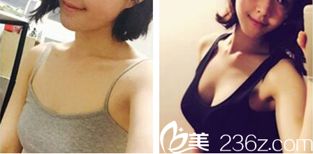 泰國曼谷KTOP整形診所班從杰假體豐胸案例