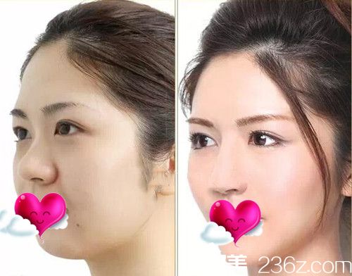 CLINICX無創(chuàng)微整形面部輪廓整形案例效果圖