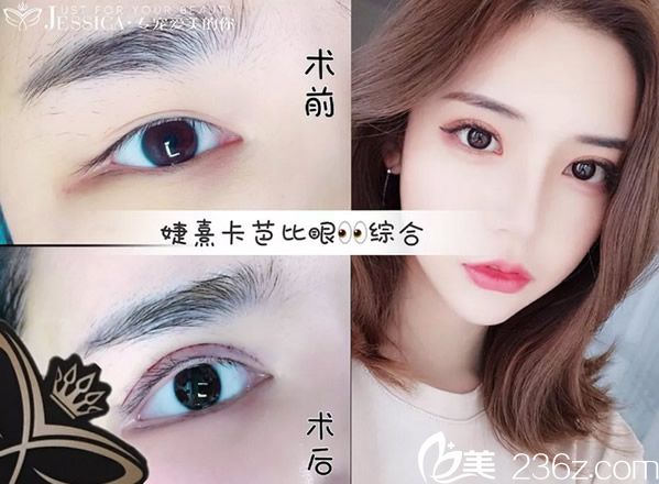 婕熹卡全切雙眼皮+開眼角真人案例