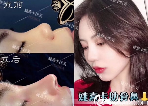 香港婕熹卡自體肋軟骨隆鼻效果案例