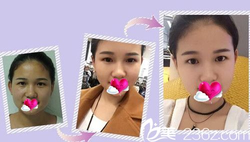 CLINICX無創(chuàng)微整形玻尿酸+案例效果圖 CLINICX無創(chuàng)微整形玻尿酸+案例效果圖