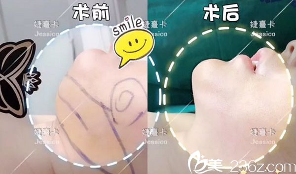 香港婕熹卡雙下巴吸脂效果怎么樣