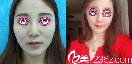 中國(guó)臺(tái)灣京媛隆鼻案例 中國(guó)臺(tái)灣京媛隆鼻案例