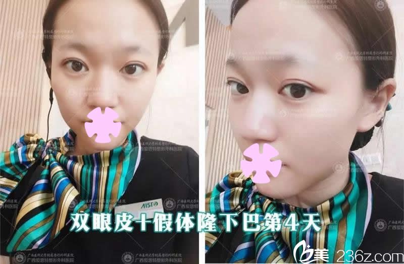 我在南寧愛(ài)思特整形做雙眼皮和假體墊下巴術(shù)后第4天照片