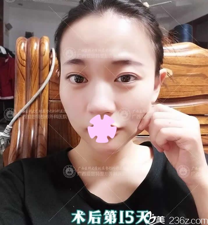 我在南寧愛(ài)思特整形做眼睛和下巴術(shù)后第15天照片