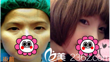 中國臺灣京媛劉賢佐醫(yī)生雙眼皮案例