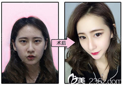 廣州紫馨谷琪雙眼皮祛眼袋脂肪填充案例 廣州紫馨谷琪雙眼皮祛眼袋脂肪填充案例