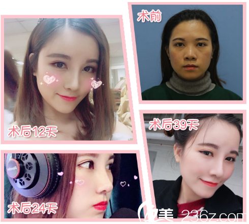 廣州紫馨谷琪做隆鼻子怎么樣 廣州紫馨谷琪做隆鼻子怎么樣