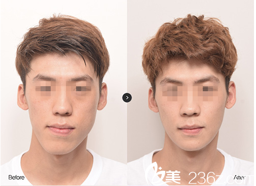 下頜角手術(shù)案例