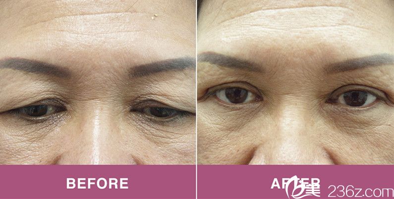 上瞼成形術(shù)前后對(duì)比照