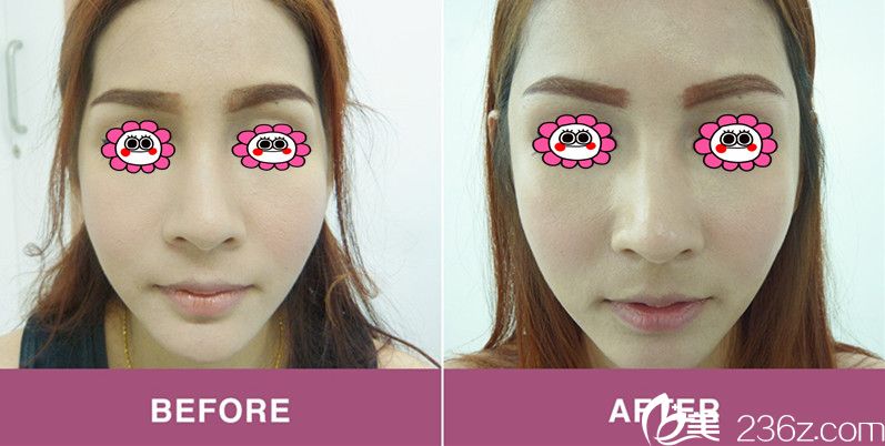 面部脂肪填充效果圖