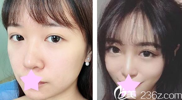王朝輝瘦臉效果對比圖 王朝輝瘦臉效果對比圖
