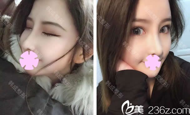 在南寧韓成整形把雙眼皮、隆鼻和瘦臉一起做了，術(shù)后竟然美成這樣