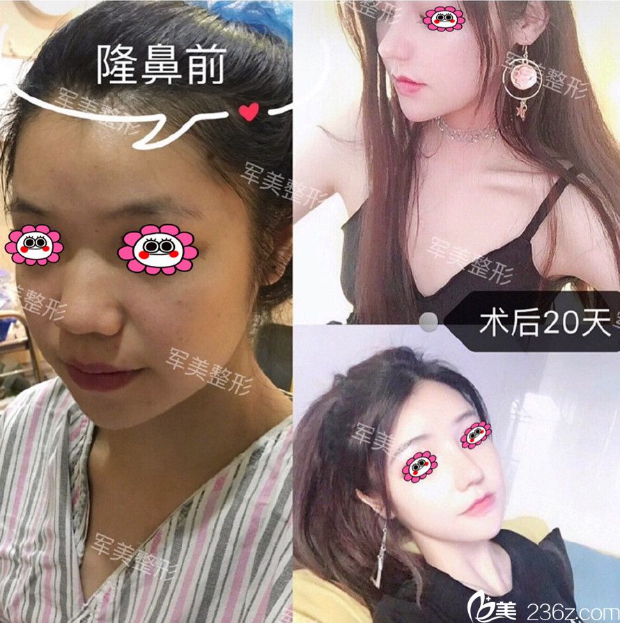 廣州軍美隆鼻案例變化圖