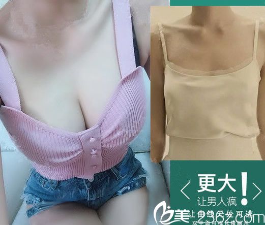 廣州軍美王世虎隆胸效果圖