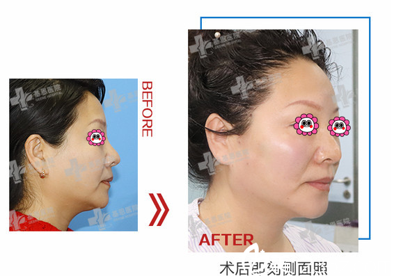 北京基恩埋線提升多少錢？全面部線雕提升7800元起附案例