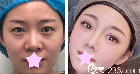 李成龍做全切雙眼+假體隆鼻效果對比圖 李成龍做全切雙眼+假體隆鼻效果對比圖