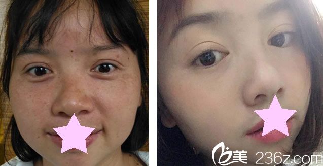 史小英醫(yī)生做激光祛斑效果對比圖 史小英醫(yī)生做激光祛斑效果對比圖