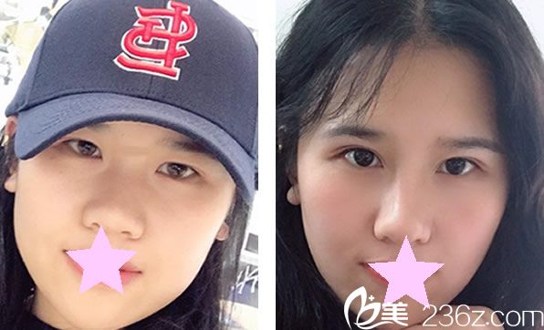 陳建軍做面部吸脂效果對比圖 陳建軍做面部吸脂效果對比圖