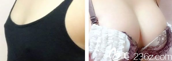 張燕熊自體脂肪豐胸效果對比圖 張燕熊自體脂肪豐胸效果對比圖