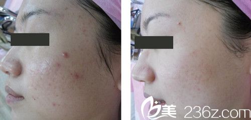 中國臺(tái)灣妮蔻時(shí)尚診所沈文示祛痘案例 中國臺(tái)灣妮蔻時(shí)尚診所沈文示祛痘案例