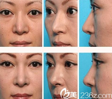 日本美容美真醫(yī)院做的鼻部修復手術案例照片 日本美容美真醫(yī)院做的鼻部修復手術案例照片