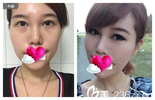 中國臺灣妮蔻時尚果酸煥膚效果圖 中國臺灣妮蔻時尚果酸煥膚效果圖