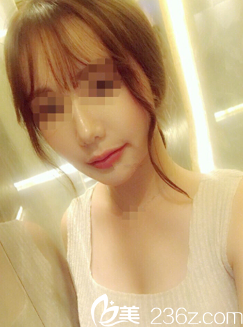 韓國EU頜面輪廓整形外科真人案例：雙顎面部縮短+不對(duì)稱校正+下頜角下巴修復(fù)附恢復(fù)圖