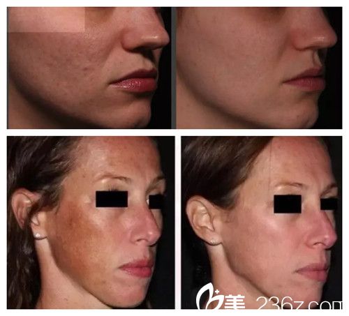 唐娜羅賓遜博士激光祛斑、祛痘坑案例